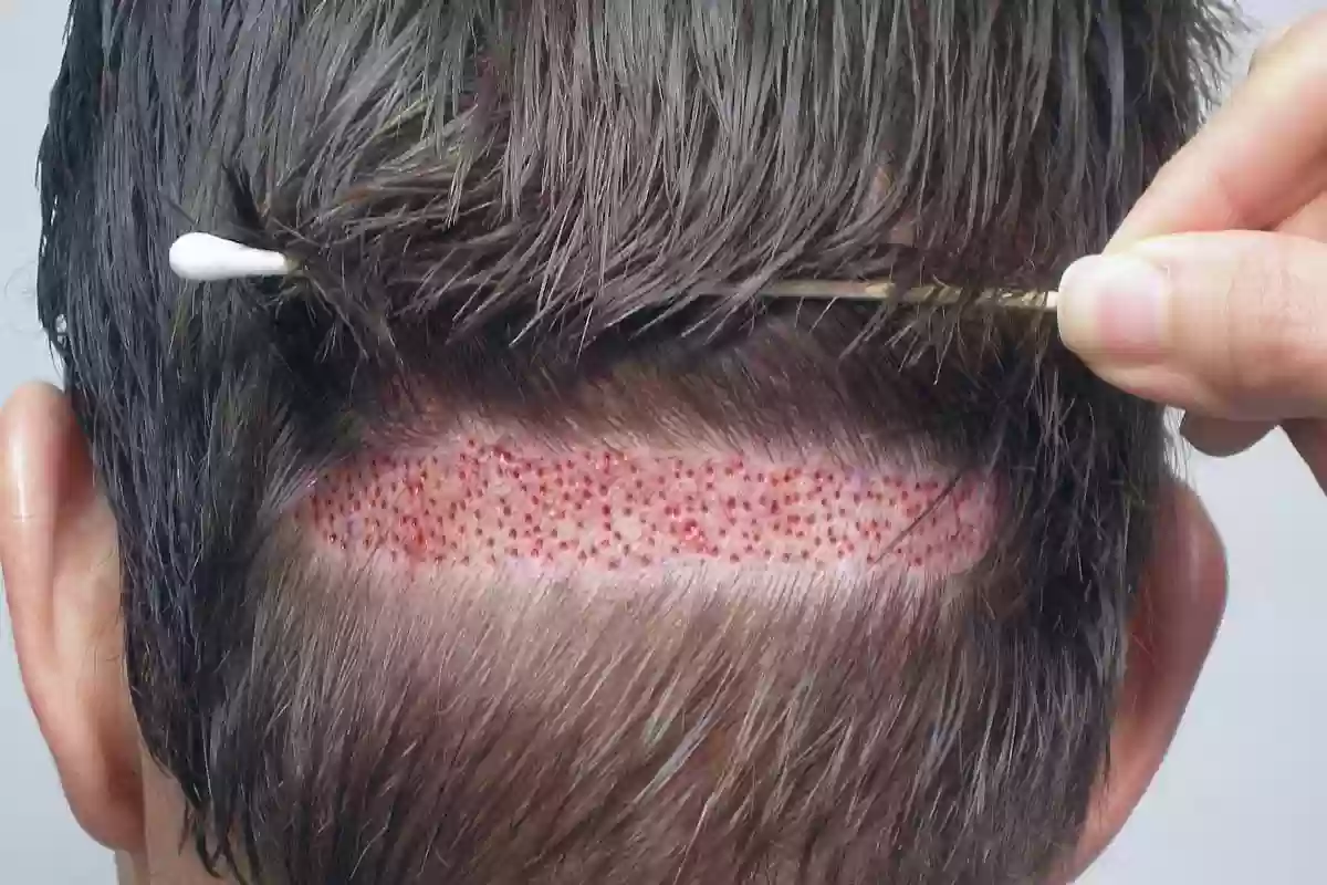 زراعة الشعر في السعودية كم تكلف؟